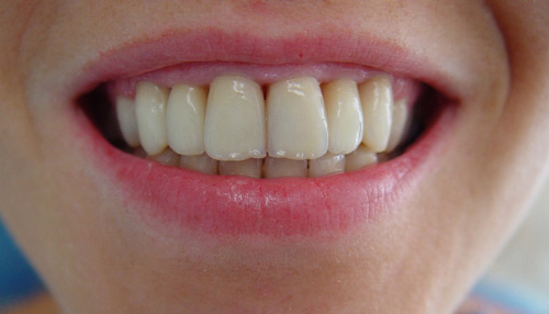 All Ceramic, Before