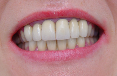 All Ceramic, After