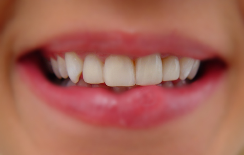 Dental Bonding, before
