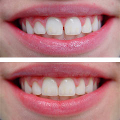 bondingbefore after2