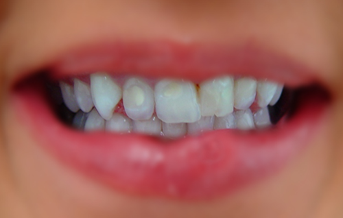 Dental Bonding, After