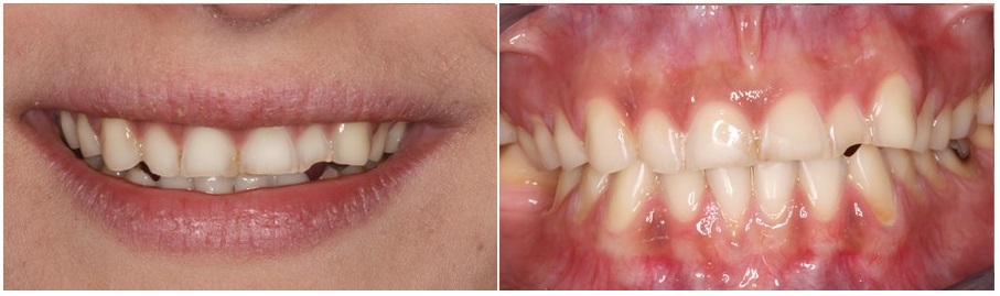 Teeth erosion