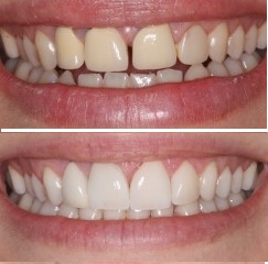 crownsbefore after9