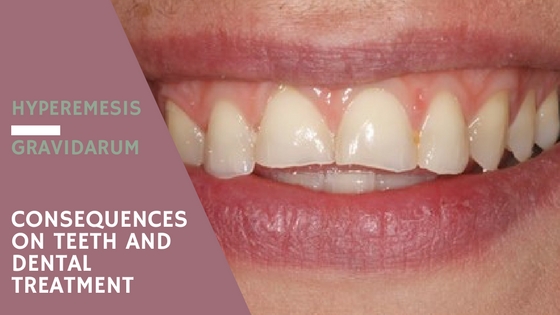 hyperemesis gravitarum-  consequences in teeth and dental treatment 