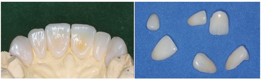 composite palatal veneers and labial porcelain veneers