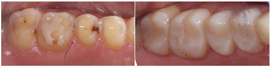 teeth erosion, before and after, the sandwich technique