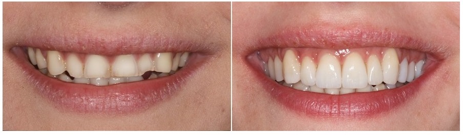 teeth erosion, before and after, the sandwich technique, adhesive additive rehabilitations