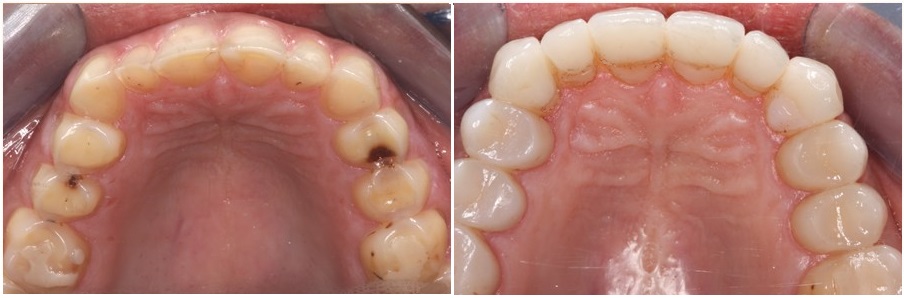 teeth erosion, before and after, occlusal view