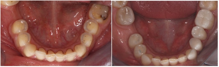 teeth erosion, before and after, occlusal view