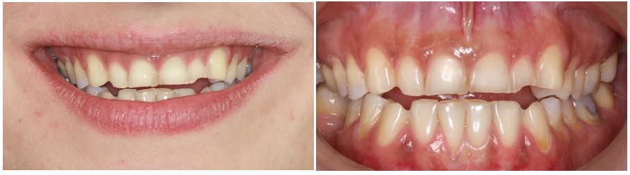 composite built ups on posterior teeth, to increase the vertical dimension of occlusion