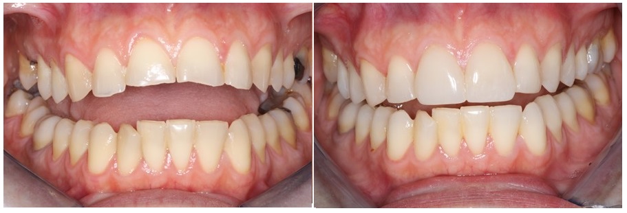 Before and after prosthetic rehabilitation of eroded teeth with bonded restorations