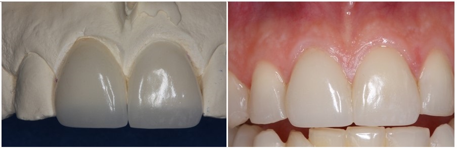 Porcelain veneers