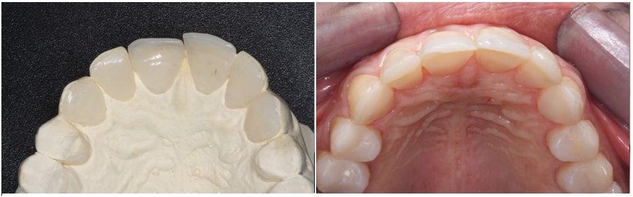 Palatal composite veneers for anterior eroded teeth