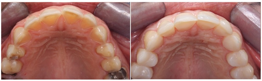 Palatal composite veneers for anterior eroded teeth-Before and after