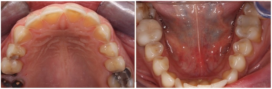 teeth erosion due to vomiting during pregnacy