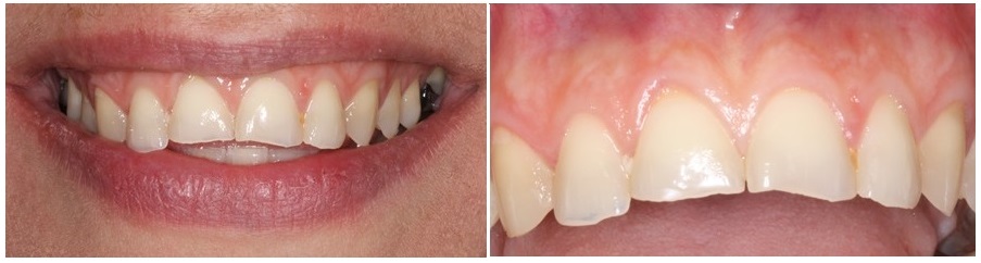 teeth erosion due to vomiting during pregnacy