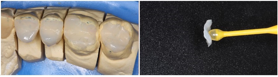 Composite onlays on posterior teeth