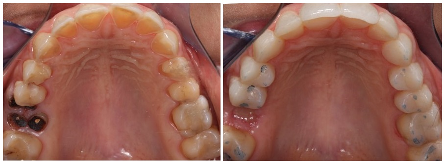 Before and after prosthetic rehabilitation of eroded teeth with bonded restorations