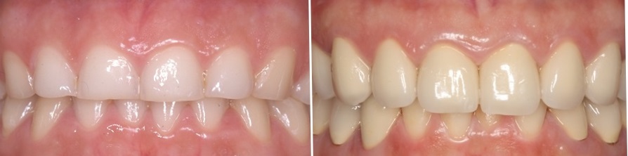 Restoration of eroded teeth with galvano-ceramic crowns