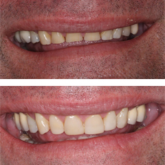 smiledesign beforeafter1