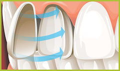 veneer3