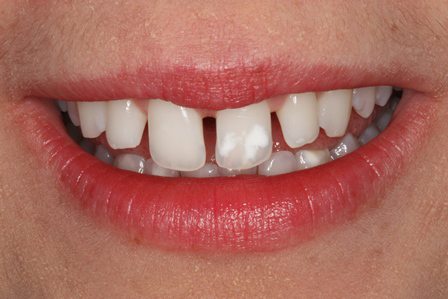 Veneers, After