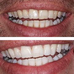 whitening3