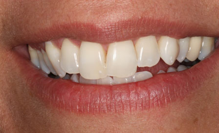 Whitening, Before