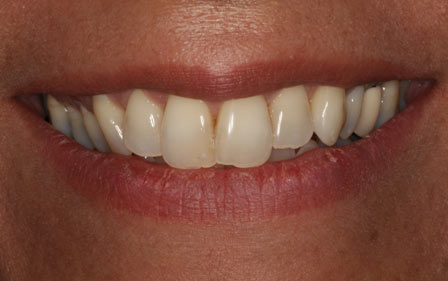 Whitening, After